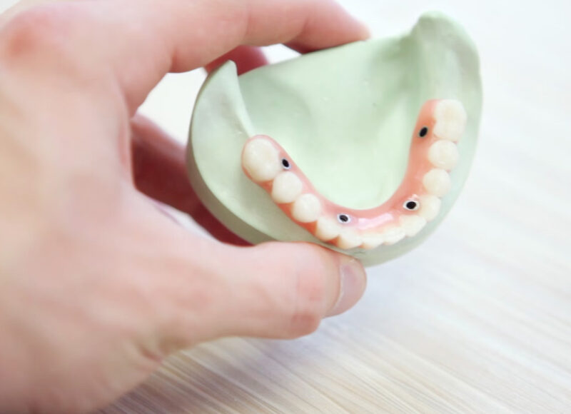 Pemasangan Gigi Palsu Dan Lepasan Permanen