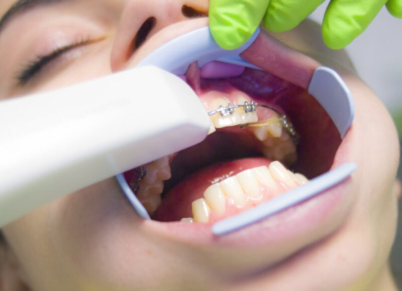 Apa Itu Perawatan Ortodontik